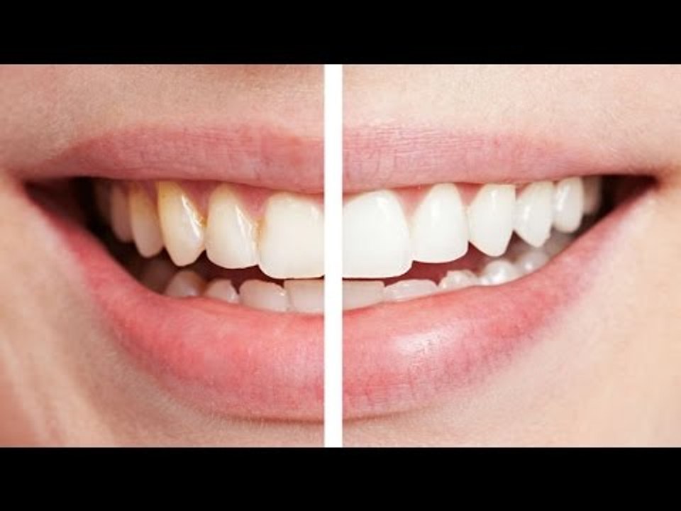 How to whiten teeth naturally at home, find out...