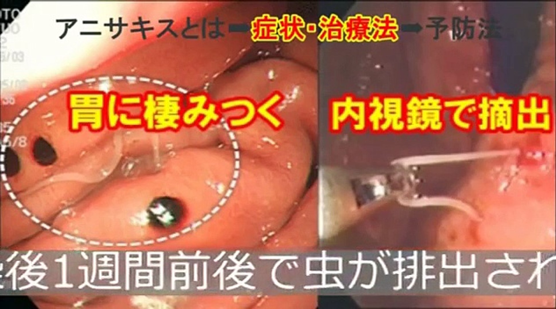恐怖 日本で急増 胃に寄生する危険な寄生虫 マンゴーワーム ウマバエより怖い 身近な寄生虫 動画 Dailymotion