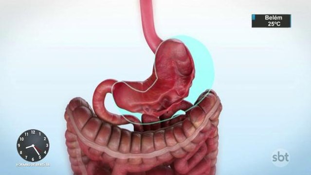 Nova técnica menos invasiva pode substituir cirurgia bariátrica