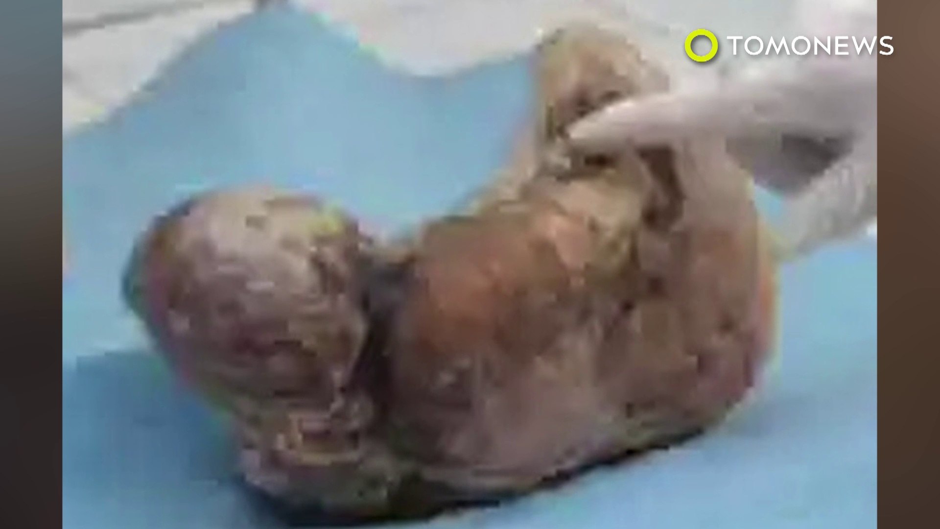 Woman Carries Ectopic Stone Baby Pregnancy In For 37 Years Video Dailymotion