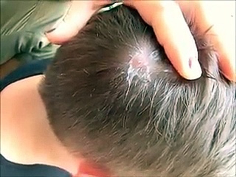 Cette femme enfonce une pince à é dans son cuir chevelu, mais ce quƞ retire de sa tê est vraiment affreux !