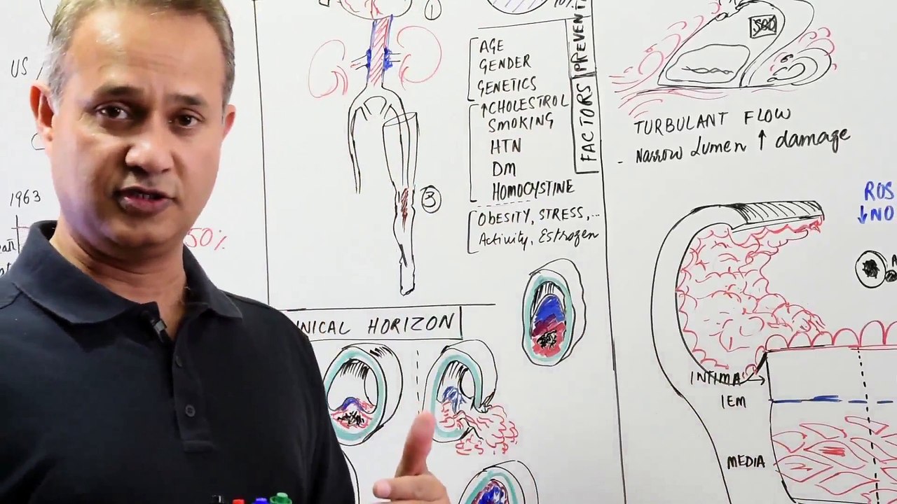 CVS Pathology Atherosclerosis (Part 2)