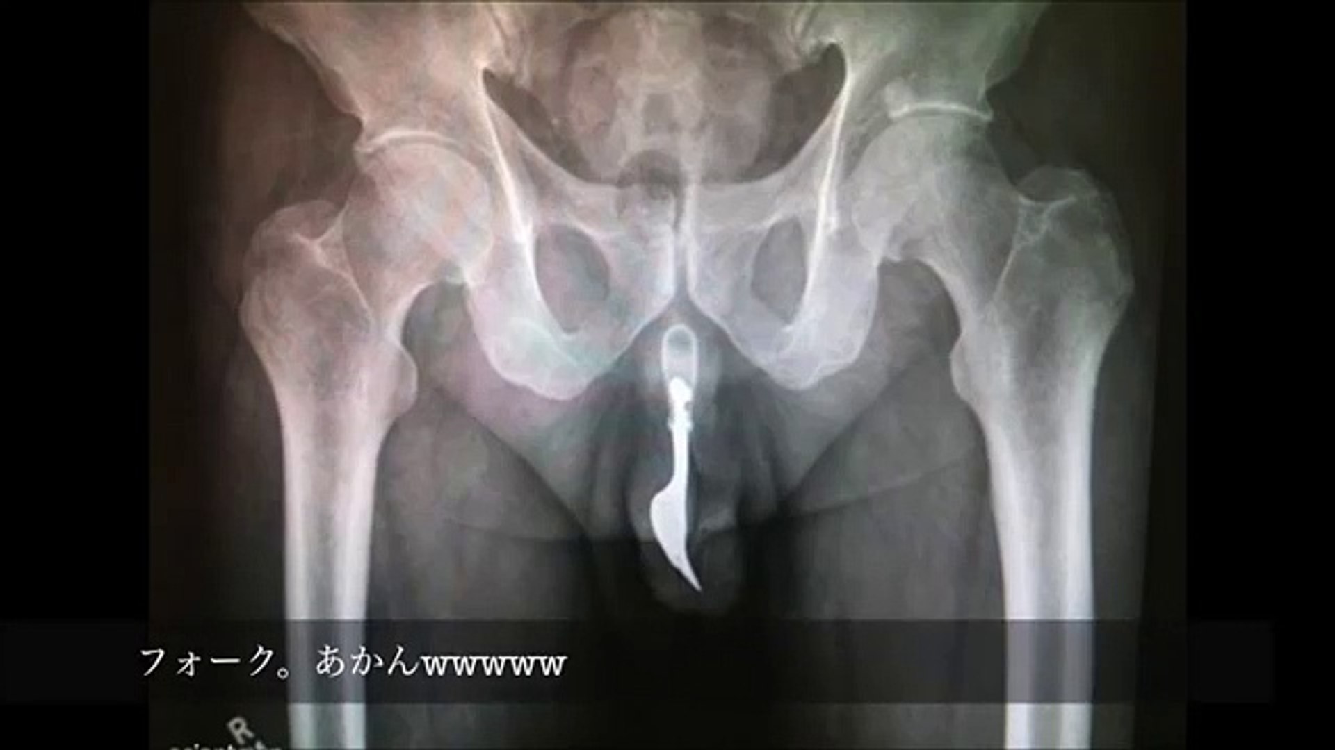 Nq 閲覧注意 こんなの入らないよ 快楽を追及しすぎたレントゲン写真がヤバいｗｗ Video Dailymotion