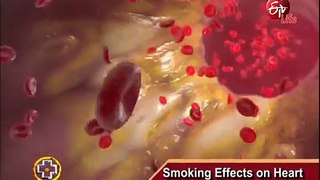 Aarogyamastu _ Smoking Effects on Heart _ 8th March 2017 _ ఆరోగ్యమస్తు-5ii-xG3HMkQ