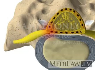 Tips for Choosing a Neurosurgeon