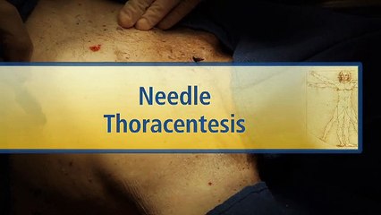 Needle Thoracentesis