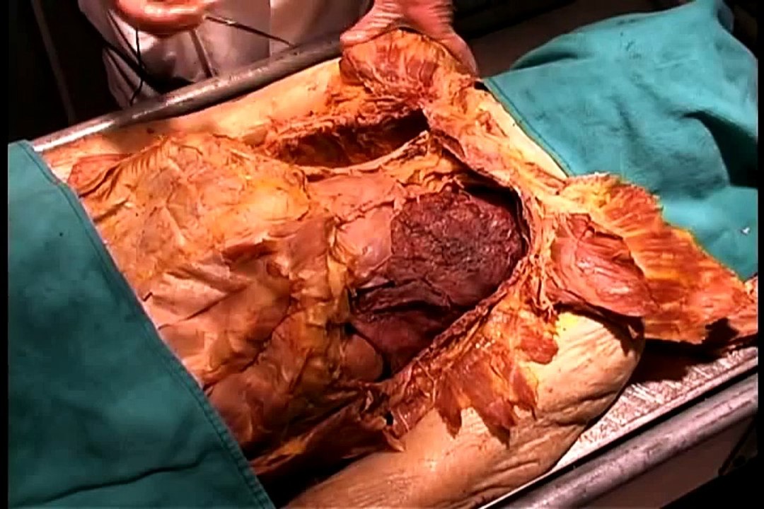 Anatomical dissection # 4_ Lungs & Pleural sacs, heart & pericardial sacs.