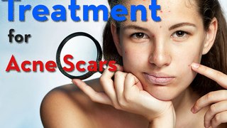 Treatment for Acne Scars1