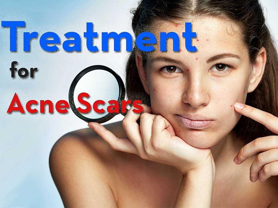 Treatment for Acne Scars1