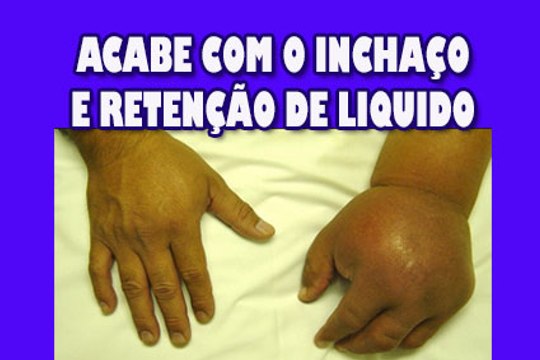 COMO ACABAR COM O INCHAÇO E RETENÇÃO DE LIQUIDOS DEFINITIVAMENTE Por Nina Della Rosa