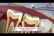 Genel Diş Tedavi Yöntemleri - Animasyon