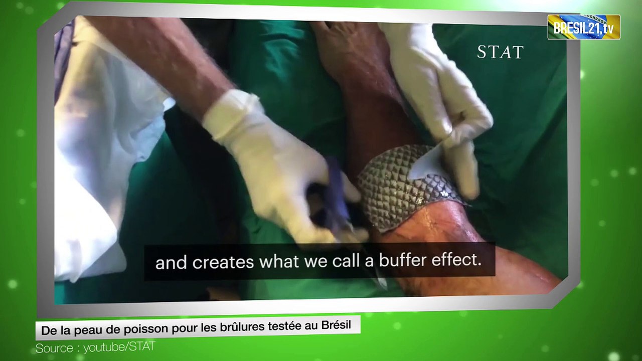 De la peau de poisson pour les brûlures testée au Brésil