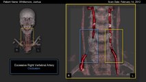 3D CTA Head Neck Scan by Fales and Fales PA