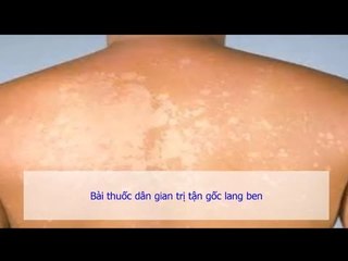 3 Bài thuốc dân gian trị tận gốc lang ben