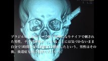 【衝撃】レントゲン画像で見る世界がヤバすぎる！① (一部閲覧注意あり)