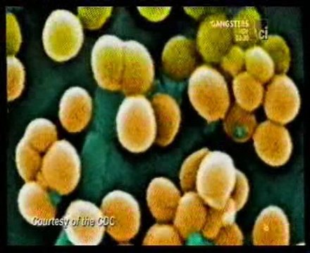 Estafilococos aureus: Autopsia forense