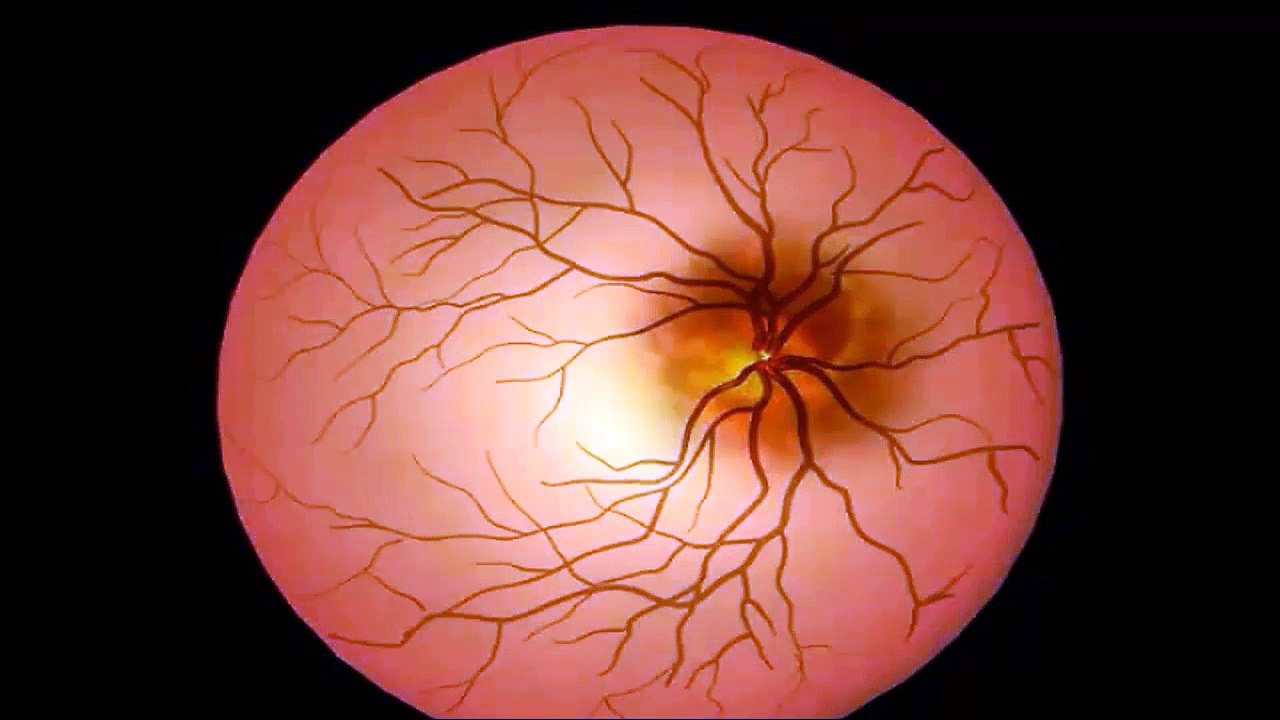 Anterior Ischemic Optic Neuropathy (AION)