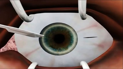 Anterior ciliary sclerotomy