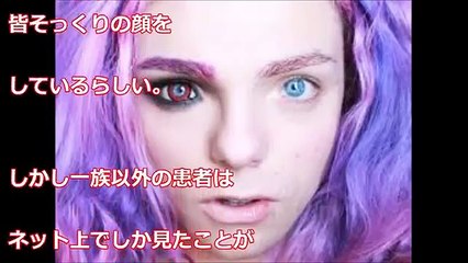 【閲覧注意】「妖精の顔」で生まれる奇病、ワールデンブルグ症候群