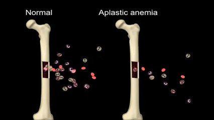 Aplastic Anemia