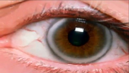 Arcus - MEDICAL DEFINITIONS