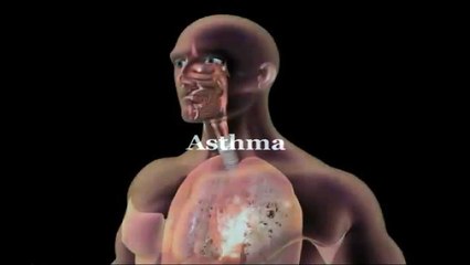 Asthma - MEDICAL DEFINITONS