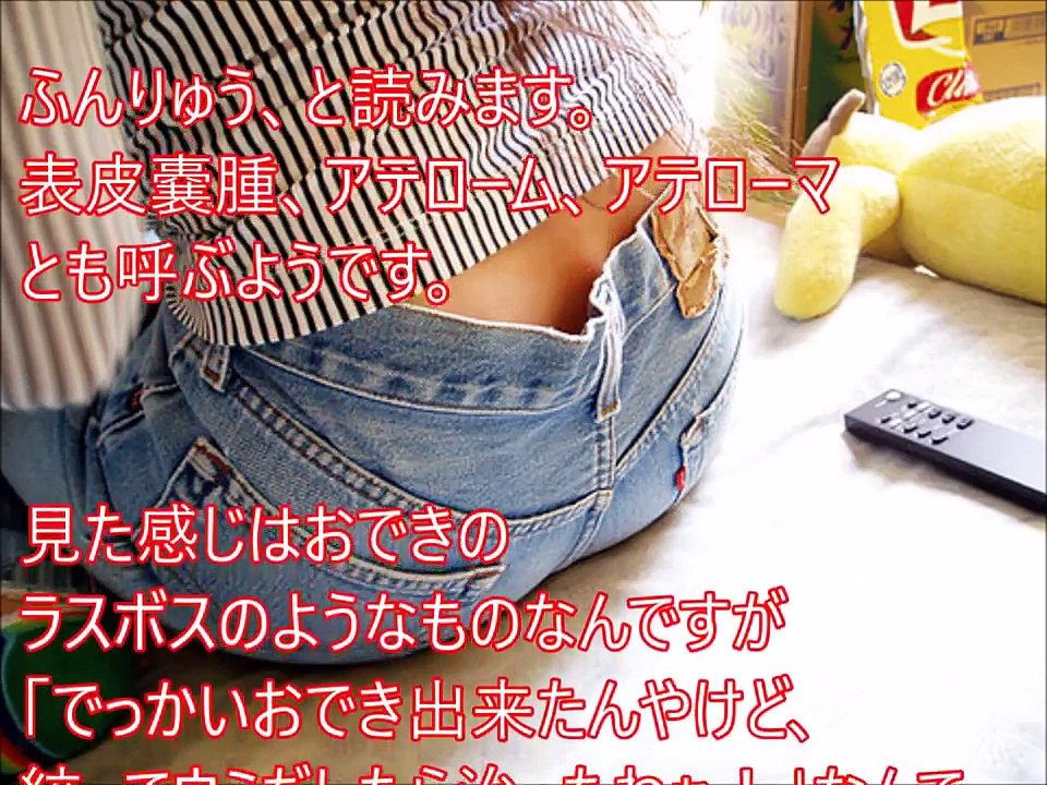 【閲覧注意】巨大角栓！？粉瘤！？年頃の女性がお尻にできた粉瘤でパニック。アテロームに悲鳴！！