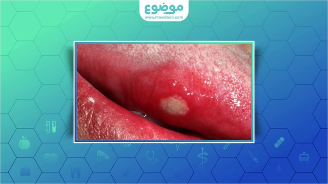 #موضوع: أنواع تقرحات اللسان وعلاجها
