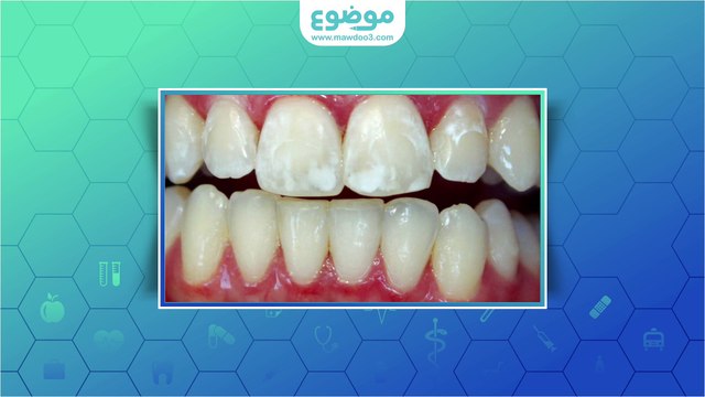 #موضوع: ما هي أعراض خراج الأسنان؟
