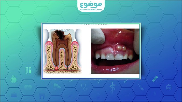 #موضوع: ما هو خراج الأسنان؟