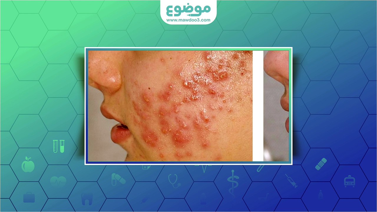 #موضوع: علاج حب الشباب الدوائي