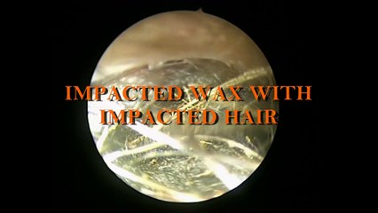 IMPACTED EAR WAX BEHIND HAIRS