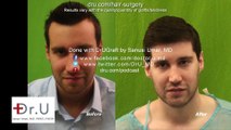 Los Angeles Best FUE Hairline Transplant Forehead Reduction Without Invasive Surgery Using Head and Nape Hair Grafts