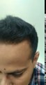 Hair Transplant Surgery in Delhi by Dr Amit Seth