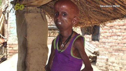 Real-life 'Benjamin Button' 21-Year-Old Who Has the Body of a 160-Year-Old