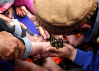 Hindistan'da Sülük Tedavisi! Birçok Hastalığa İyi Geliyor