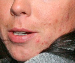 Los efectos perversos del fármaco "Roacután", muy eficaz contra el acné