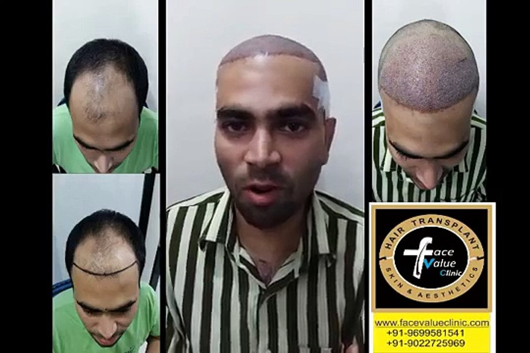 face value hair transplant FUE-cheap & best