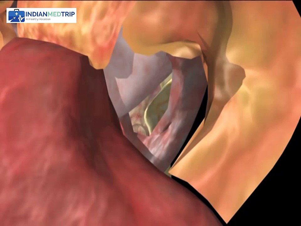 Is Radical Prostatectomy an Effective Treatment For Prostate Cancer