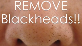 How to Get Rid of Blackheads at Home || Home Remedies