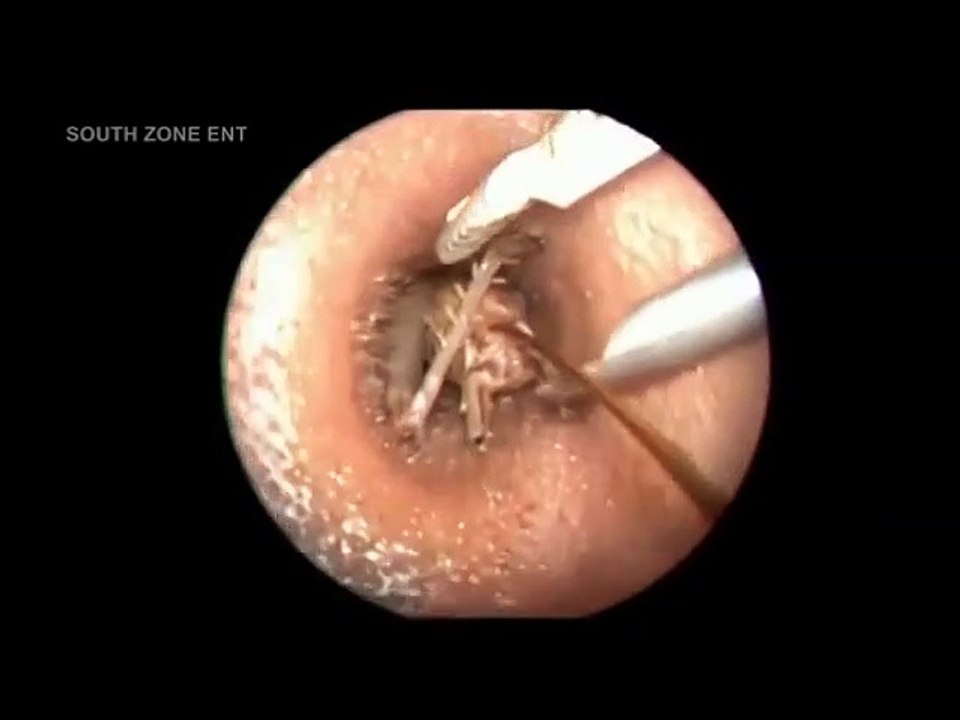 extraction de pus dans le dos