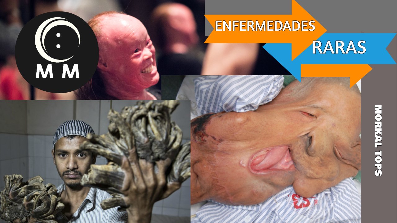Top 5 Personas con Enfermedades Raras