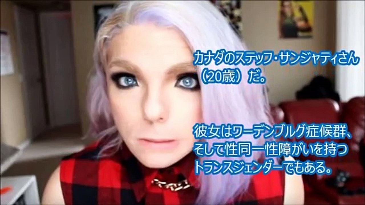 【閲覧注意】「妖精の顔」で生まれる奇病、世界が震えた！ワールデンブルグ症候群。嘘のような本当の驚くべき奇病がヤバすぎる・・・