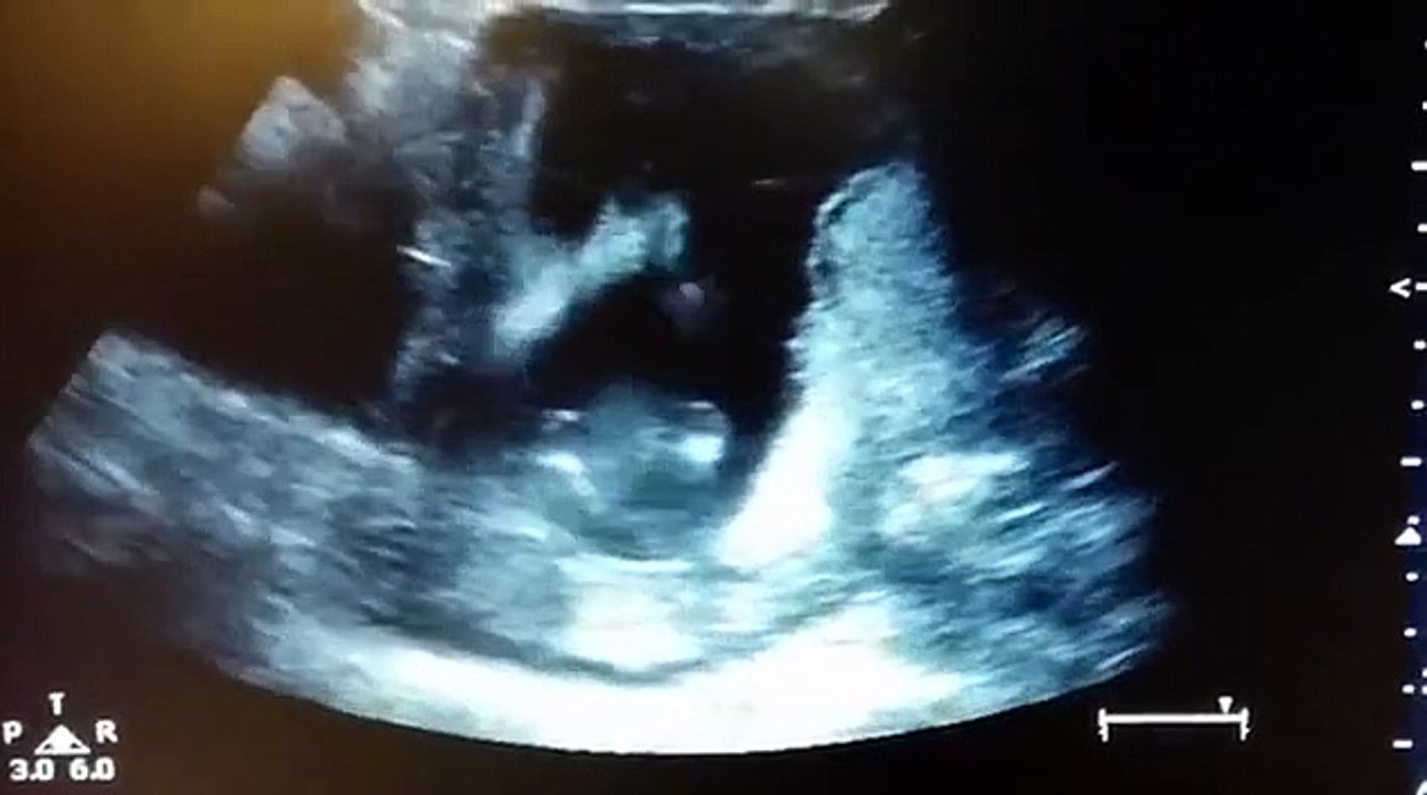 Une échographie montre un bébé frapper dans ses mains
