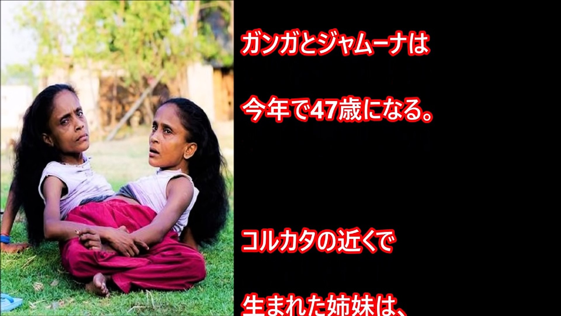 閲覧注意 結合双生児の人たちの結婚 夫婦の営み事情とは 女性編 シャム双生児 Video Dailymotion