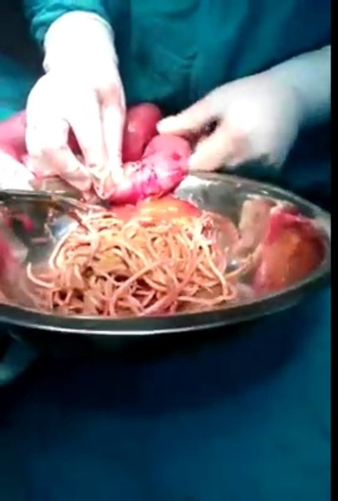 Spaghetti pasta (Noodles) stuck in big intestine