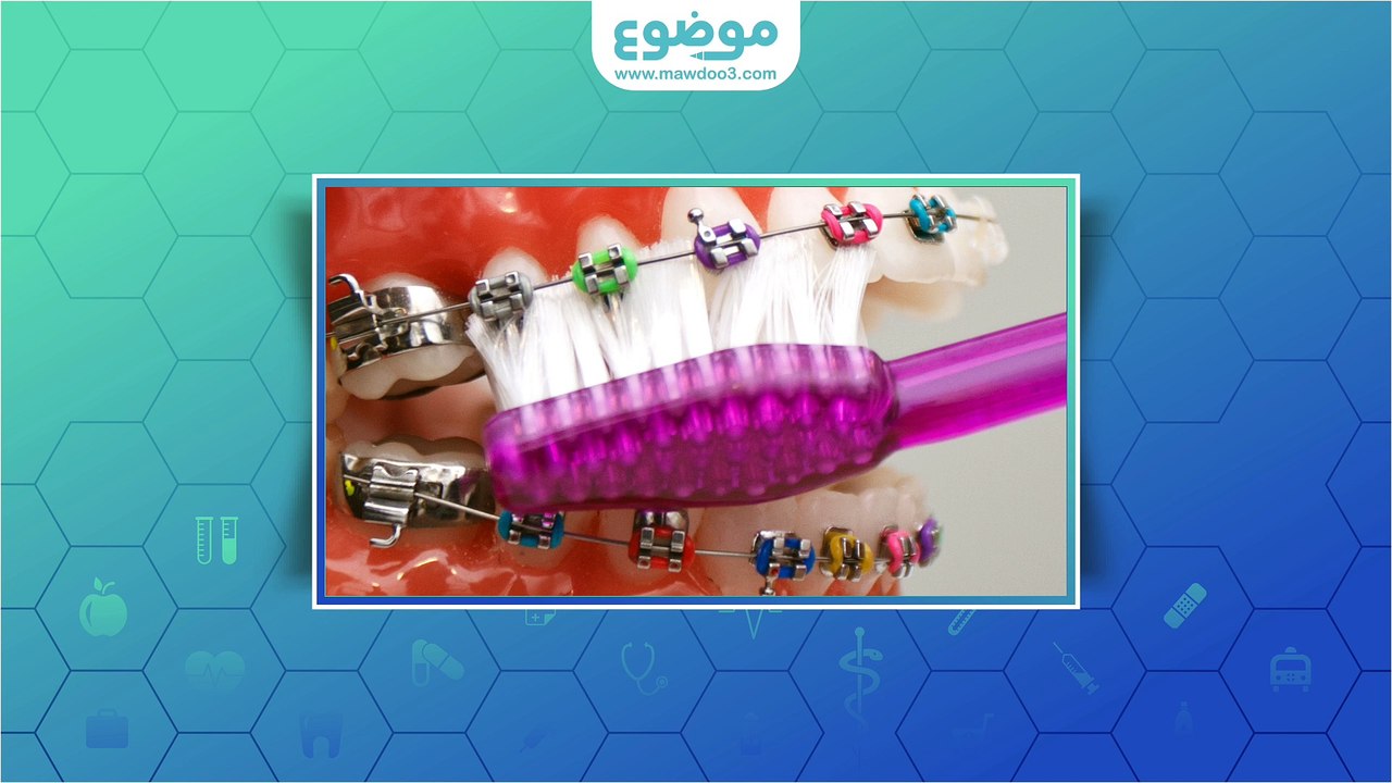 #موضوع: ما هي أضرار تقويم الأسنان
