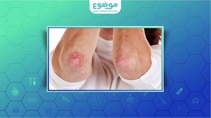 #موضوع: ما هي أنواع الصدفية؟