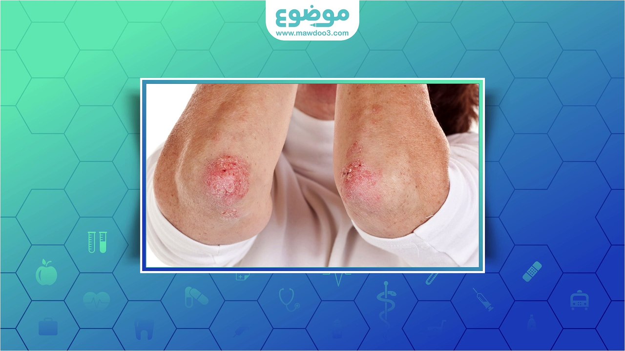 #موضوع: ما هي أنواع الصدفية؟