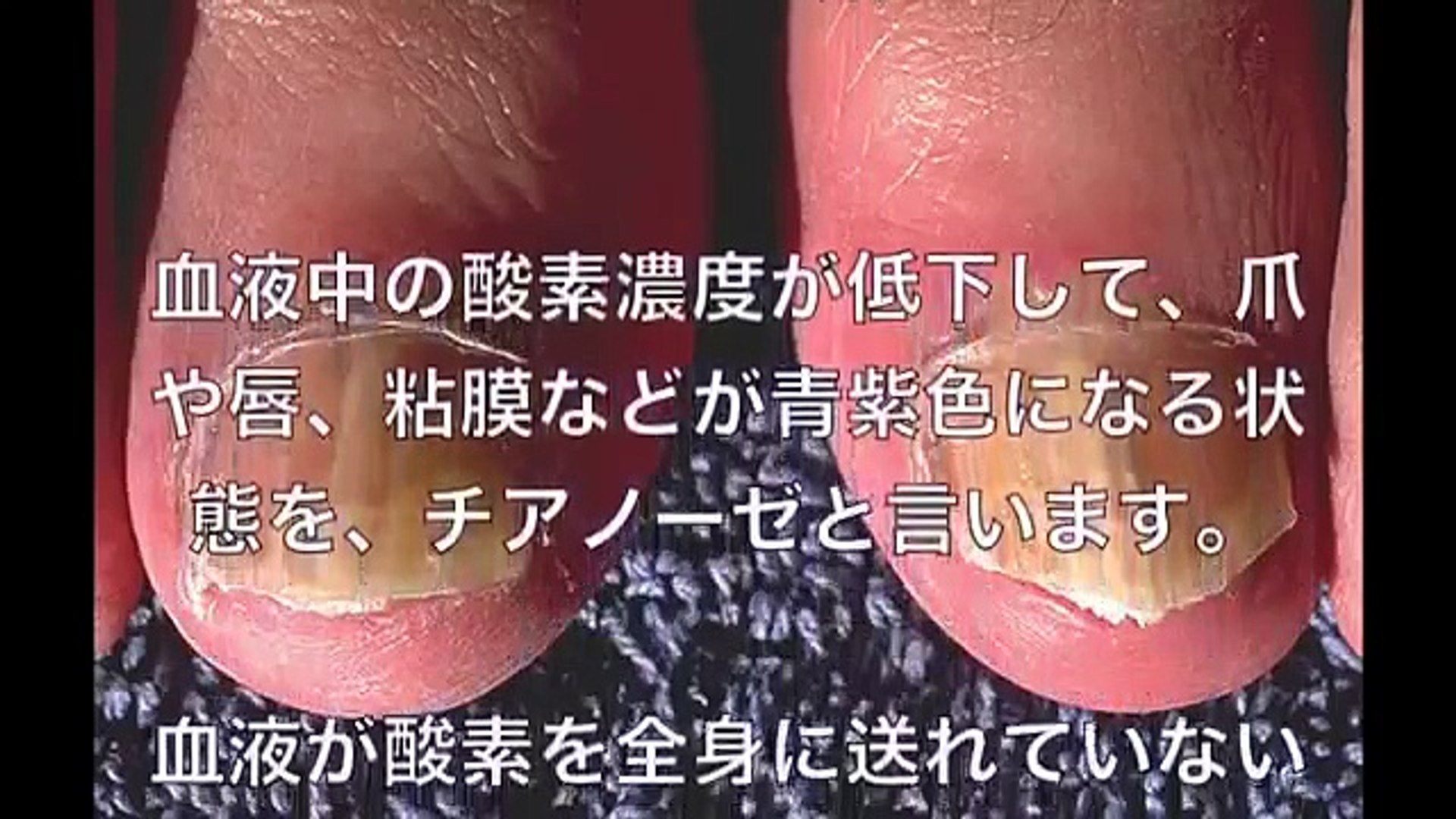 健康 爪で診る健康 この12の症状は病気のサイン マジっすか Health Health Check With Nails Video Dailymotion